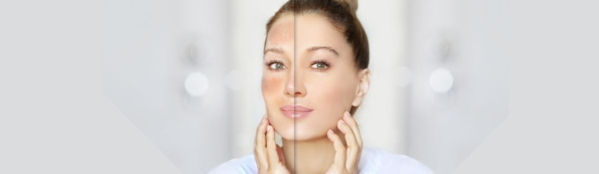 MaxOzone Beyazlatıcı ve Leke Kremi Slider