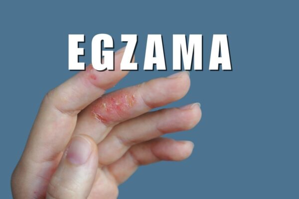 En Etkili Egzama Kremi hangisi? MaxOzone EG1 Egzama Kremi